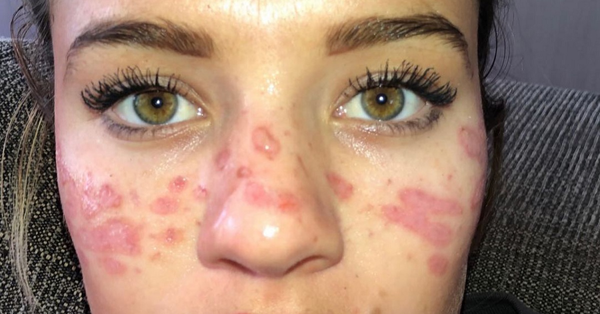 Influencer sufre quemaduras en el rostro tras intentar truco de Tik Tok