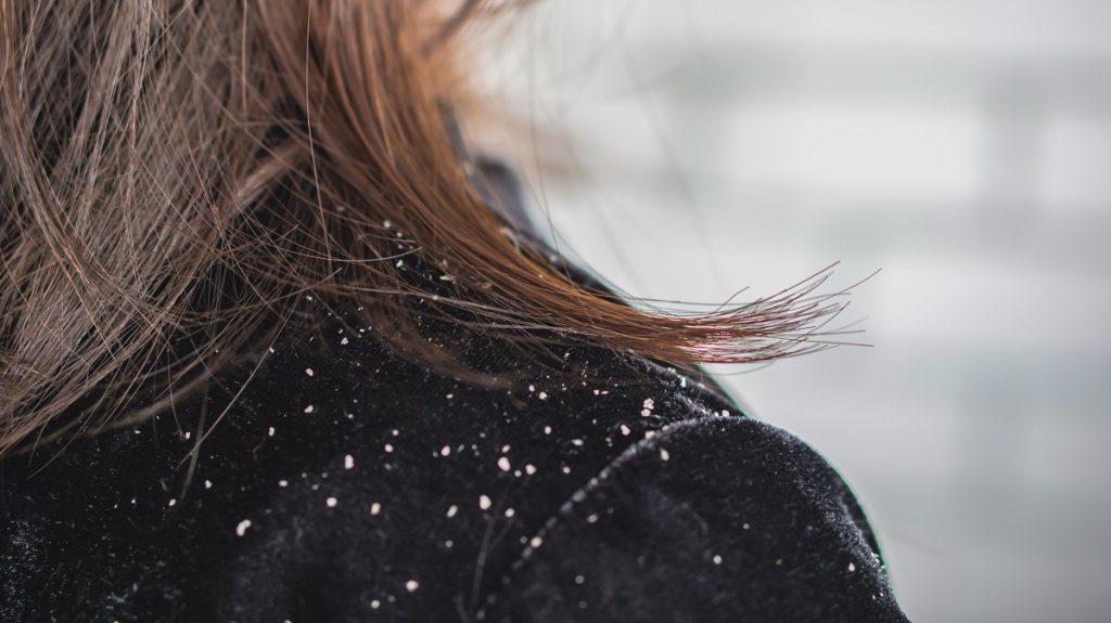 ¿Cómo eliminar la caspa con productos que tenemos en nuestras casas?